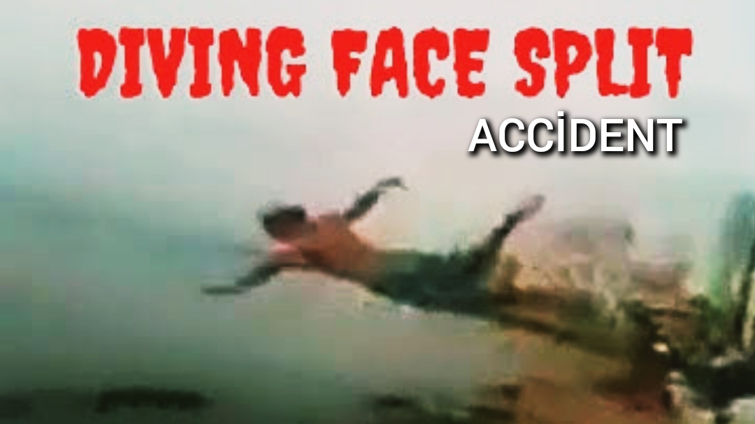 Split Face Diving Accident 2009